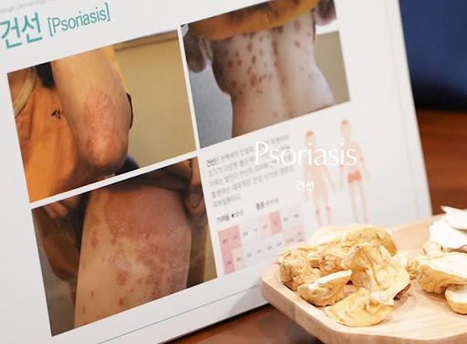 생기한의원 건선 페이지에서 안내하는 피부 자극 주의사항